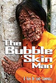 El hombre de la piel de la burbuja